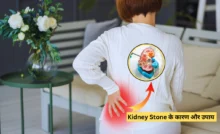 Kidney Stone की समस्या: डॉक्टर ने बताए कारण और इसे रोकने के लिए जरूरी सलाह।